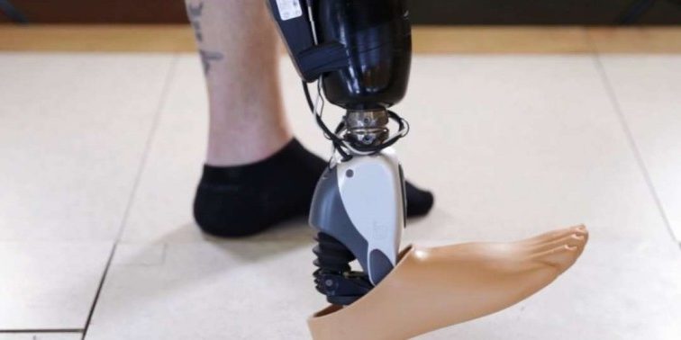 ossur sensor controlled bionic foot